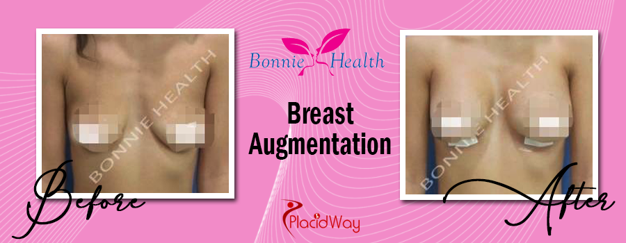 Before & After Breast Augmentation